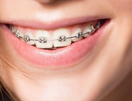 Choosing The Best Orthodontic Treatment For Your Teen: Part Two | Common Brace Types for Your Teen