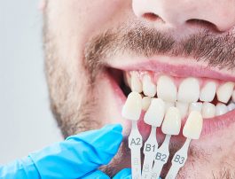 5 Benefits of Porcelain Veneers